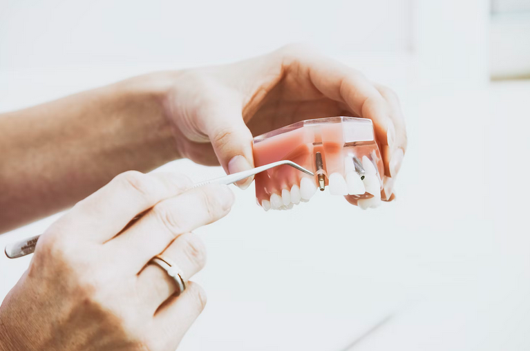 Unraveling the Truth: Debunking Common Myths About Dental Implants