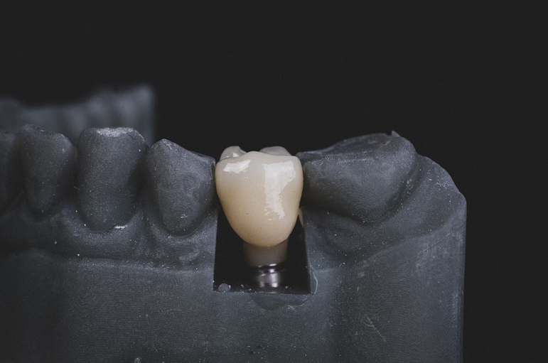 What to Expect After Getting Dental Implants